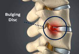 Disc Bulge Pain