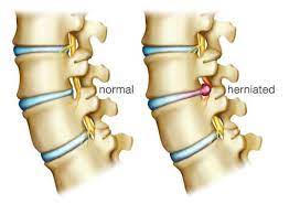 Disc Herniation Pain